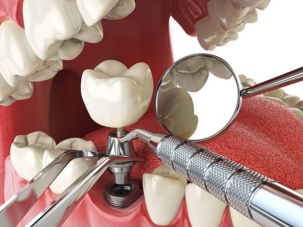 Best Urgent Care for Lost Fillings or Crowns in Hollywood Park, TX
